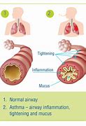 Image result for Lungs of a Person with Asthma