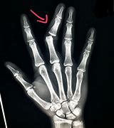 Image result for PA Finger X-ray