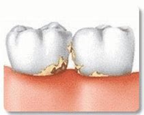 Image result for Teeth with Yellow Stuff