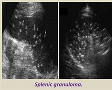 Image result for Spleen Infarction Ultrasound