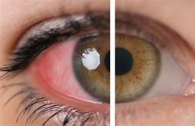 Image result for Uveitis Eye Disease