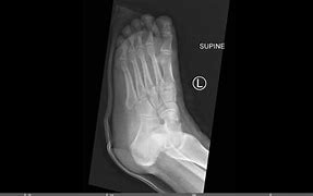 Image result for Lisfranc Orif