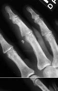 Image result for Volar Fracture