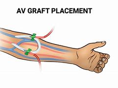 Image result for AV Graft