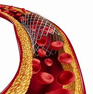 Image result for SCV Thrombosis