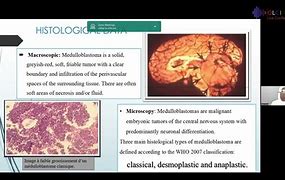 Image result for Medulloblastoma in Child