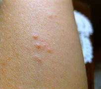 Image result for Bed Bug Bite On Eye