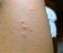 Image result for Baby Bed Bug Bites