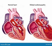 Image result for Dilated Cardiomyopathy EKG