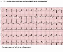 Image result for RVH ECG