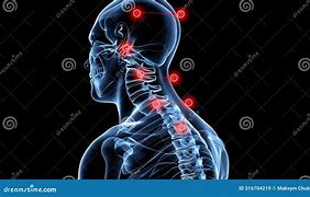 Image result for Spinal Neck Pain