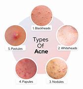 Image result for Infected Acne Pustules