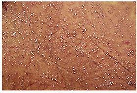 Image result for Pustules Back