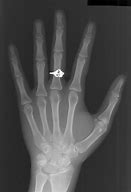 Image result for Bone Age Hand X-ray