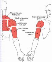 Image result for Upper Arm Pain