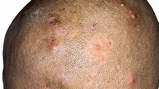 Image result for Bacterial Folliculitis Scalp