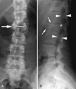 Image result for Lumbar Compression Burst Fractures