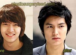 Image result for Lee Min Ki Plastic Surgery