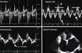 Image result for Pericarditis EKG Findings Example