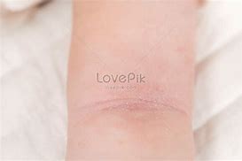 Image result for Eczema On Baby Arm