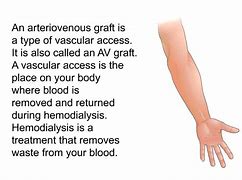 Image result for AV Graft