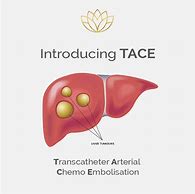 Image result for Tace Ablation