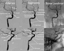 Image result for Distal Carotid Aneurysm MRI