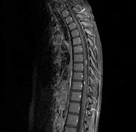 Image result for Abnormal Thoracic Spine MRI