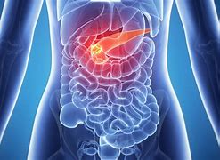 Image result for Pancreatic Cancer