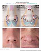 Image result for Nasal Alar Groove