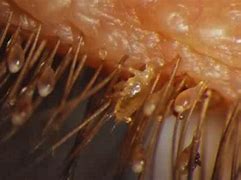 Image result for Eyelash Mites Symptoms