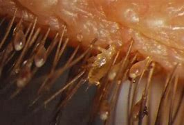 Image result for Eyelash Worms