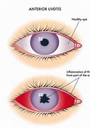 Image result for Uveitis Eye Disease