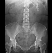 Image result for Kidney On X-ray