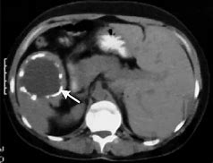 Image result for Cyst On Spleen