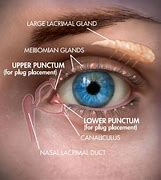 Image result for Punctal Occlusion