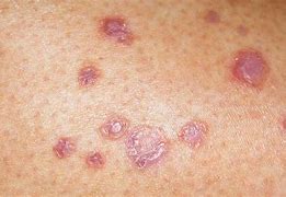 Image result for Diabetic Rash