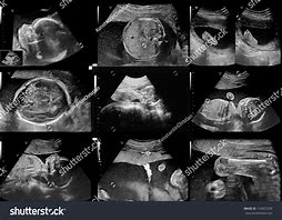 Image result for Baby Ultrasound Photo