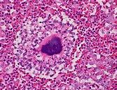 Image result for Actinomycetoma