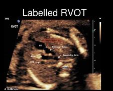 Image result for Rvot and LVOT Fetal Ultrasound Images Colour