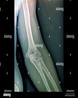 Image result for Normal Elbow Joint