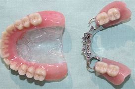 Image result for Upper Partial Dentures Pictures