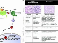 Image result for Shh Pathway Medulloblastoma