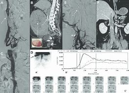 Image result for IVC Thrombs Post-Mortem