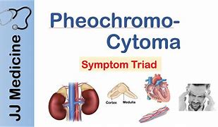 Image result for 5 Ps of Pheochromocytoma