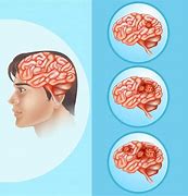 Image result for Brain Cancer Photo Human