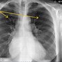 Image result for Pulmonary Edema Fluid Overload