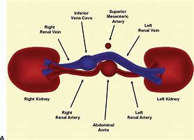 Image result for Retrocaval Artery