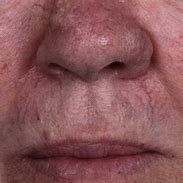 Image result for Nose Lesions