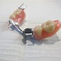 Image result for Metal-Based Partial Dentures